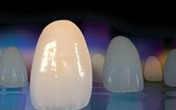 Nhổ răng bao lâu có thể trồng răng sứ? Nhổ răng bao lâu có thể trồng răng sứ?