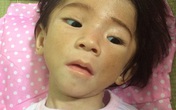 Bé gái 14 tháng nặng chỉ 3,5 kg thay da đổi thịt sau 1 tuần được chăm sóc Bé gái 14 tháng nặng chỉ 3,5 kg thay da đổi thịt sau 1 tuần được chăm sóc