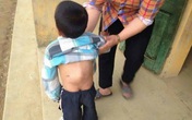 Xót xa bé 6 tuổi còng lưng vì khối u Xót xa bé 6 tuổi còng lưng vì khối u