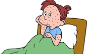 Những sai lầm hay gặp khi trẻ bị thủy đậu Những sai lầm hay gặp khi trẻ bị thủy đậu
