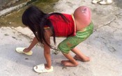 Bé gái Mông có khối u dị thường, đủ chân tay vẫn phải đi bằng 4 chi Bé gái Mông có khối u dị thường, đủ chân tay vẫn phải đi bằng 4 chi