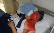 Tự chế thuốc pháo, nam sinh bị bỏng nặng