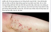 Chuốc họa vì cơn lốc tiếp thị làm đẹp đón hè (3): Tiêm làm trắng vô tình phá hủy làn da Chuốc họa vì cơn lốc tiếp thị làm đẹp đón hè (3): Tiêm làm trắng vô tình phá hủy làn da