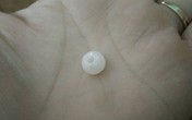 Mẹ hốt hoảng phát hiện hạt cườm trong hốc mũi con sau khi đi mẫu giáo về Mẹ hốt hoảng phát hiện hạt cườm trong hốc mũi con sau khi đi mẫu giáo về
