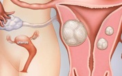 Nguyên nhân và cách phòng ngừa u xơ tử cung hiệu quả Nguyên nhân và cách phòng ngừa u xơ tử cung hiệu quả