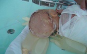 Mẹ bất cẩn để con ngã ngồi vào nồi canh nóng 25 lít Mẹ bất cẩn để con ngã ngồi vào nồi canh nóng 25 lít