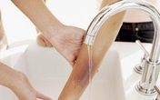 Những việc nên và không nên làm khi trẻ bị bỏng nước sôi Những việc nên và không nên làm khi trẻ bị bỏng nước sôi