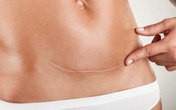 10 lý do bạn nên cảm thấy hài lòng vì đã sinh mổ 10 lý do bạn nên cảm thấy hài lòng vì đã sinh mổ