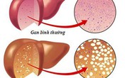 7 dấu hiệu không ngờ tới cảnh báo gan của bạn đang xấu đi 7 dấu hiệu không ngờ tới cảnh báo gan của bạn đang xấu đi