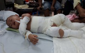 Mẹ câm điếc, bố mù, con trai 10 tháng tuổi nguy kịch vì bỏng nặng Mẹ câm điếc, bố mù, con trai 10 tháng tuổi nguy kịch vì bỏng nặng