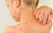 Bố mẹ nhầm thủy đậu với bệnh sởi, nhiều trẻ nguy kịch Bố mẹ nhầm thủy đậu với bệnh sởi, nhiều trẻ nguy kịch