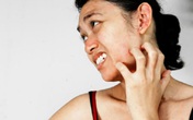 Trời nồm ẩm, gia tăng bệnh da liễu Trời nồm ẩm, gia tăng bệnh da liễu