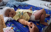 Bé gái bị ngã vào bếp lửa phải lấy da của bố để cấy ghép Bé gái bị ngã vào bếp lửa phải lấy da của bố để cấy ghép