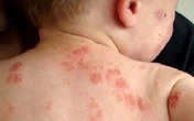 Khi côn trùng đốt, chớ lạm dụng mẹo dân gian Khi côn trùng đốt, chớ lạm dụng mẹo dân gian