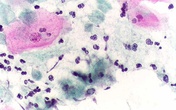 Nấm Candida sinh dục - 'cứng đầu' nhưng không bất trị Nấm Candida sinh dục - 'cứng đầu' nhưng không bất trị