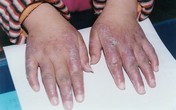 Phòng bệnh mùa lạnh: Chiều chuộng làn da “ngứa như điên” thế nào? Phòng bệnh mùa lạnh: Chiều chuộng làn da “ngứa như điên” thế nào?