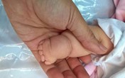Tay chân bé có ngấn tưởng bụ bẫm, hóa ra bị vòng thắt Tay chân bé có ngấn tưởng bụ bẫm, hóa ra bị vòng thắt