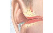 Mùa hè trẻ đi bơi nhiều, đây là cách để giúp trẻ tránh bị viêm tai giữa Mùa hè trẻ đi bơi nhiều, đây là cách để giúp trẻ tránh bị viêm tai giữa