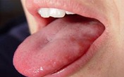 Giám đốc BV Ung bướu cảnh báo 3 dấu hiệu vùng đầu cổ phải nghĩ ngay đến ung thư lưỡi Giám đốc BV Ung bướu cảnh báo 3 dấu hiệu vùng đầu cổ phải nghĩ ngay đến ung thư lưỡi