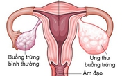 6 dấu hiệu cảnh báo bệnh ung thư buồng trứng, chị em cần lưu ý 6 dấu hiệu cảnh báo bệnh ung thư buồng trứng, chị em cần lưu ý