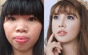 Bỏ 200 triệu để thẩm mỹ mặt, "Thị Nở tái sinh" đổi đời ra sao? Bỏ 200 triệu để thẩm mỹ mặt, "Thị Nở tái sinh" đổi đời ra sao?