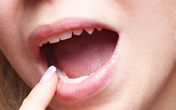 Sùi mào gà ở lưỡi biểu hiện thế nào? Sùi mào gà ở lưỡi biểu hiện thế nào?