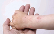 Nhập viện vì bệnh ngoài da lúc trở mùa Nhập viện vì bệnh ngoài da lúc trở mùa