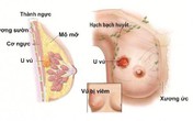 Tắm chung với con gái, mẹ phát hiện điểm bất thường trên ngực nhờ đó cứu sống con Tắm chung với con gái, mẹ phát hiện điểm bất thường trên ngực nhờ đó cứu sống con