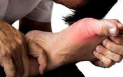 Người nào dễ bị bệnh gút? Người nào dễ bị bệnh gút?