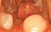 Nguyên PGĐ Bệnh viện K: Loại ung thư di truyền nhiều nhất, cần tầm soát sớm kẻo muộn Nguyên PGĐ Bệnh viện K: Loại ung thư di truyền nhiều nhất, cần tầm soát sớm kẻo muộn