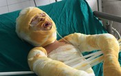 Xót xa gia đình có 3 người bỏng nặng vì cháy nhà, tính mạng nguy kịch Xót xa gia đình có 3 người bỏng nặng vì cháy nhà, tính mạng nguy kịch