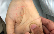 Mùa nắng nóng, cao điểm bệnh dại gia tăng Mùa nắng nóng, cao điểm bệnh dại gia tăng