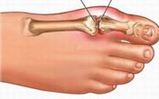 Những thực phẩm người bị bệnh gút cần tuyệt đối tránh Những thực phẩm người bị bệnh gút cần tuyệt đối tránh