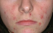 Kinh hoàng với chứng viêm da Demodex Kinh hoàng với chứng viêm da Demodex