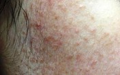 Nhiễm khuẩn, hỏng da vì muốn sạch ngay mụn trứng cá Nhiễm khuẩn, hỏng da vì muốn sạch ngay mụn trứng cá