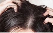 Hãi hùng những cách trị chấy “bá đạo” của người lớn cho trẻ Hãi hùng những cách trị chấy “bá đạo” của người lớn cho trẻ