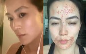 Từ một cô gái có làn da trắng mịn hồng hào, nữ phóng viên mắc chứng bệnh với mụn nổi khắp miệng ai cũng phát sợ Từ một cô gái có làn da trắng mịn hồng hào, nữ phóng viên mắc chứng bệnh với mụn nổi khắp miệng ai cũng phát sợ
