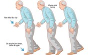Người cao tuổi bị Parkinson nên biết những điều này Người cao tuổi bị Parkinson nên biết những điều này