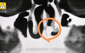 Sụt sịt 3 tháng liền, chàng trai đi khám thì phát hiện ra chiếc răng... 20 năm tuổi trong lỗ mũi Sụt sịt 3 tháng liền, chàng trai đi khám thì phát hiện ra chiếc răng... 20 năm tuổi trong lỗ mũi