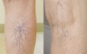 Những đường "vằn vện" ở chân: Căn bệnh nguy hiểm nhiều người mắc cả chục năm mà không biết Những đường "vằn vện" ở chân: Căn bệnh nguy hiểm nhiều người mắc cả chục năm mà không biết