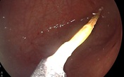 Cháu gái 1 tuổi khạc máu đỏ tươi, bà ngoại hốt hoảng biết lý do Cháu gái 1 tuổi khạc máu đỏ tươi, bà ngoại hốt hoảng biết lý do