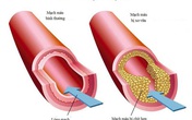 Lipidcleanz - Giải pháp giảm cholesterol, hạ mỡ máu hiệu quả! Lipidcleanz - Giải pháp giảm cholesterol, hạ mỡ máu hiệu quả!