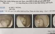 Chỉ một triệu chứng này, đi khám ra ung thư giai đoạn cuối Chỉ một triệu chứng này, đi khám ra ung thư giai đoạn cuối