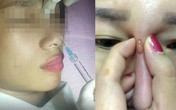 Từ vụ cô gái bị mù mắt sau khi nâng mũi, chuyên gia chỉ cách làm đẹp an toàn Từ vụ cô gái bị mù mắt sau khi nâng mũi, chuyên gia chỉ cách làm đẹp an toàn
