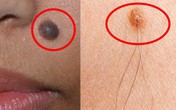 Nốt ruồi cứ có lông sẽ là ung thư? Nốt ruồi cứ có lông sẽ là ung thư?