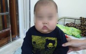 Bé 17 tháng phù mặt bất thường, tăng cân siêu tốc, suy thượng vì bố mẹ cho uống loại thuốc này Bé 17 tháng phù mặt bất thường, tăng cân siêu tốc, suy thượng vì bố mẹ cho uống loại thuốc này