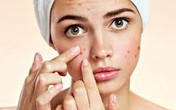 Tuổi 50 mọc nhiều trứng cá, vì sao? Tuổi 50 mọc nhiều trứng cá, vì sao?