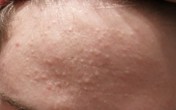 Tổng quan mụn trứng cá Tổng quan mụn trứng cá