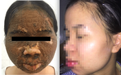 Thay đổi bất ngờ trên gương mặt cô gái trẻ sùi như vỏ mít sau khi dùng thuốc làm trắng Thay đổi bất ngờ trên gương mặt cô gái trẻ sùi như vỏ mít sau khi dùng thuốc làm trắng