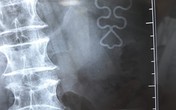 Vòng tránh thai đi "lạc" lên vị trí không ai ngờ của người phụ nữ 65 tuổi Vòng tránh thai đi "lạc" lên vị trí không ai ngờ của người phụ nữ 65 tuổi